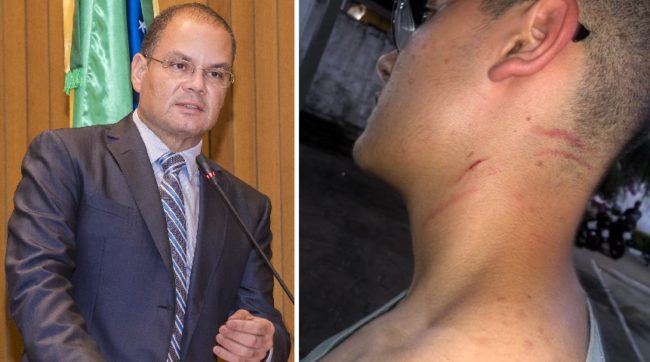 Gustavo Carvalho mostra marcas da agressão que teria sofrido pelo secretário de Estado